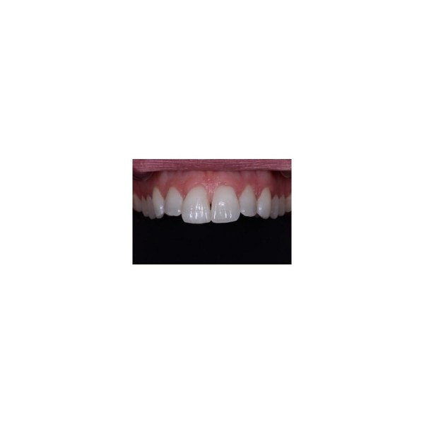 soft-contrastor-occlusal (2)1